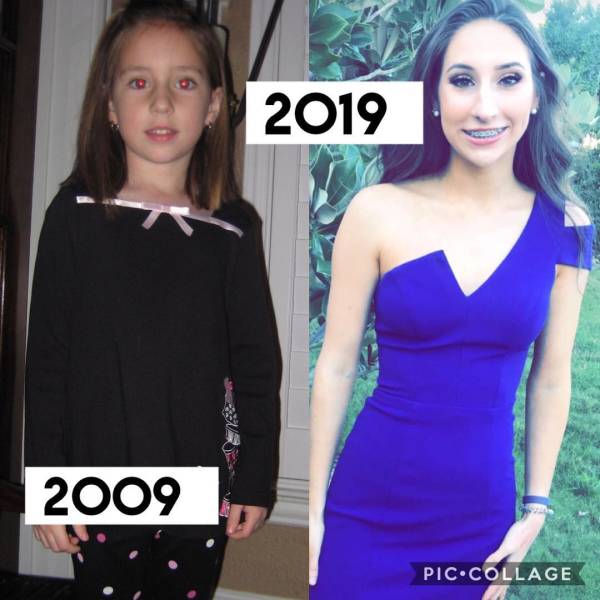 Girl Spends $10,000 On Rhinoplasty After Being Called A “Toucan” By A School Bully