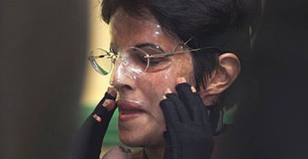 Incredible Healing after a Bomb Explosion (15 pics)