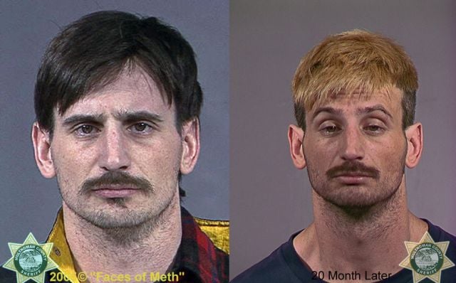 Meth Addicts: Before and After