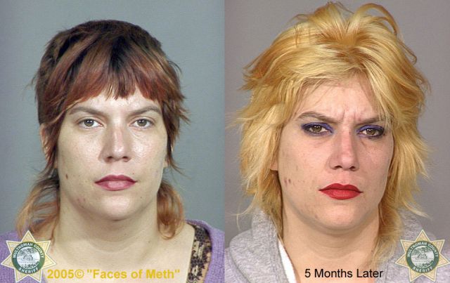 Meth Addicts: Before and After