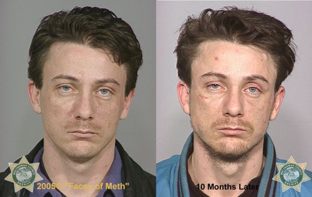 Meth Addicts: Before and After