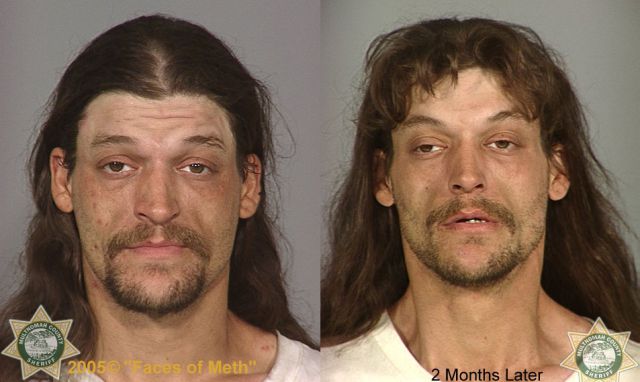 Meth Addicts: Before and After