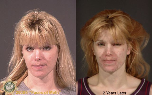 Meth Addicts: Before and After