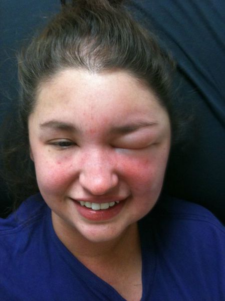 What a Brown Recluse Spider Bite Looks Like