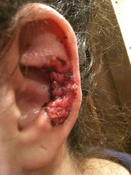 What a Brown Recluse Spider Bite Looks Like